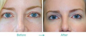 upper eyelid surgery eyesthetica