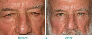 upper and lower blepharoplasty repair