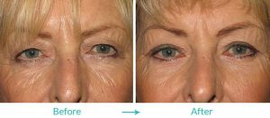 Eyesthetica upper blepharoplasty