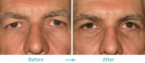 upper eyelid surgery procedure