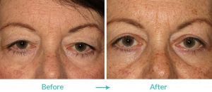 Dual eyelid procedrues at eyesthetica