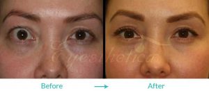 thyroid treatment and eyelid lift procedure