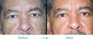 case 031 upper blepharoplasty