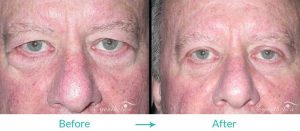 blepharoplasty for men