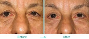 upper blepharoplasty and entropion surgery california