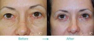 puffy upper eyelids procedure