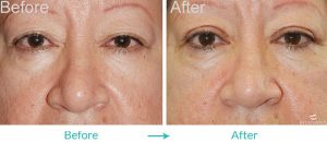 Top Eyelid Lift Surgery Los Angeles