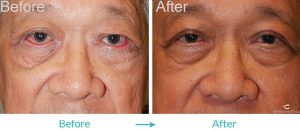 Upper Eyelid Blepharoplasty Procedure for Both Women and Men