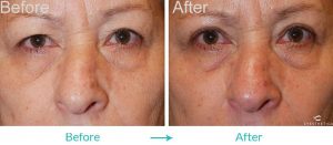 Eyelid Lift Surgery
