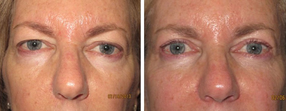 Eyelid Lift Before and After