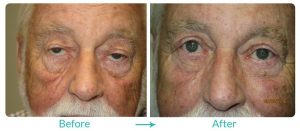 upper-blepharoplasty-ectropion-case-224