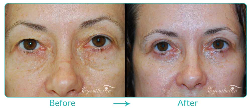 puffy upper eyelids procedure