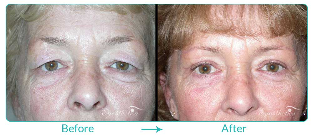 Eyesthetica upper blepharoplasty eyelid lift