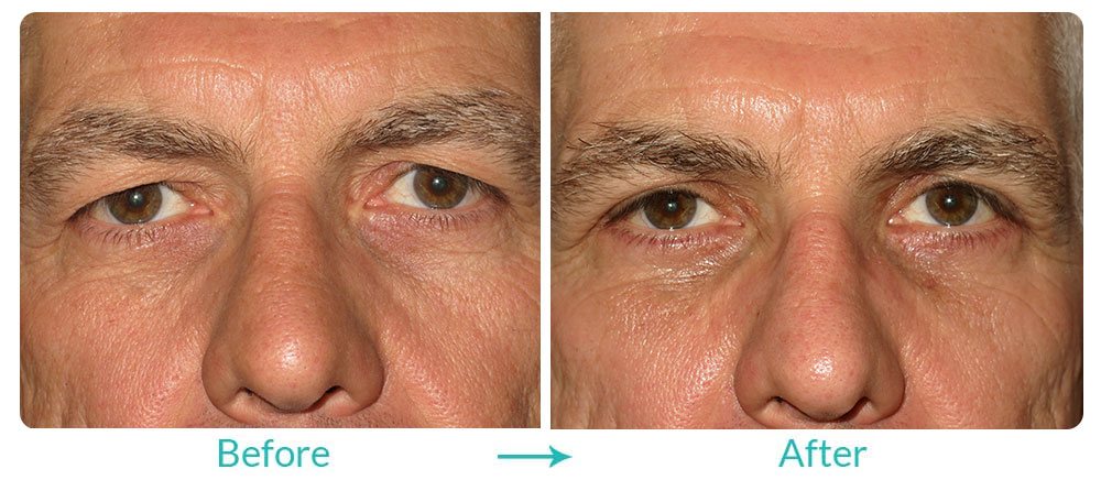 upper eyelid surgery procedure