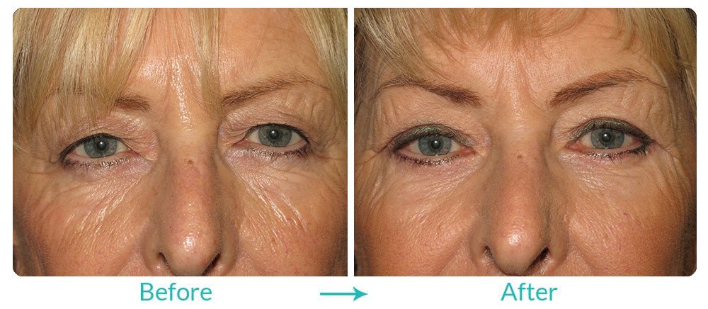 Eyesthetica upper blepharoplasty