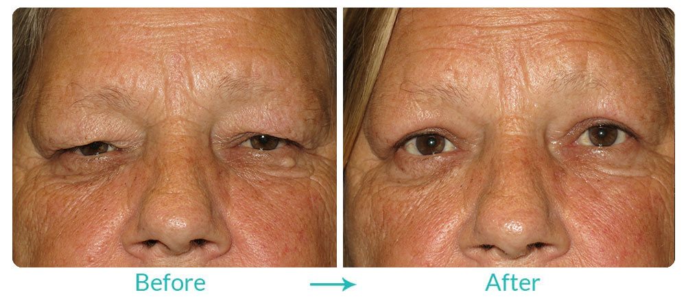 best upper blepharoplasty surgery in Los Angeles