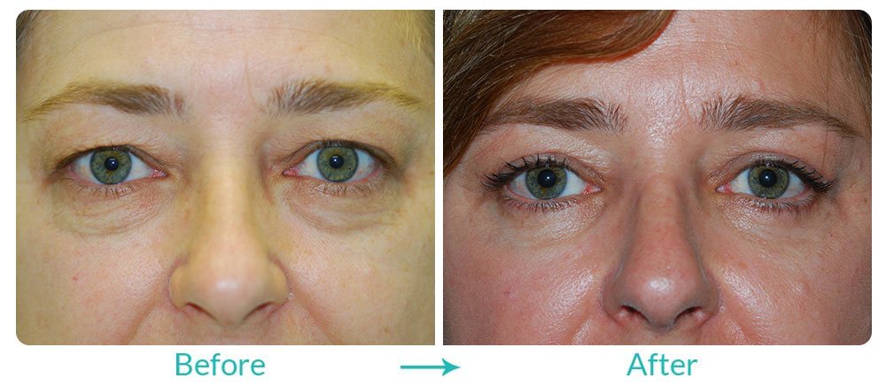 Upper blepharoplasty eyelid lift case-210