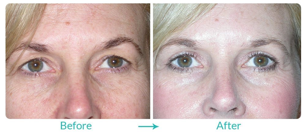 upper blepharoplasty eyelid lift surgery