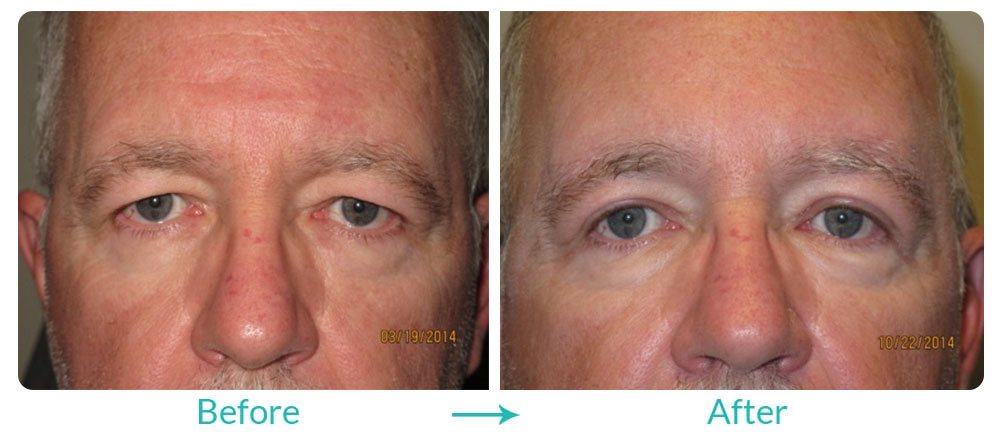 Case 222 best eyelid lift procedure for men