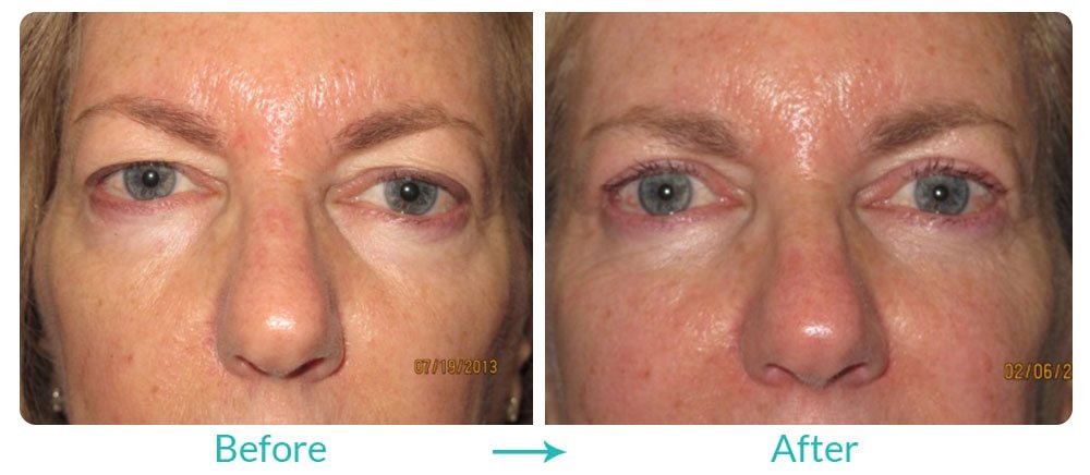 Case 238 best eyelid lift procedure in Los Angeles