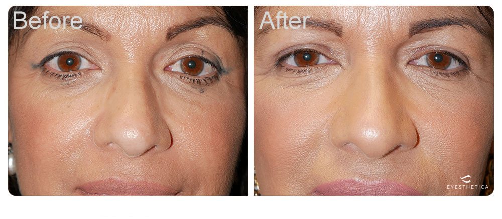 Upper blepharoplasty eyelid lift case-269