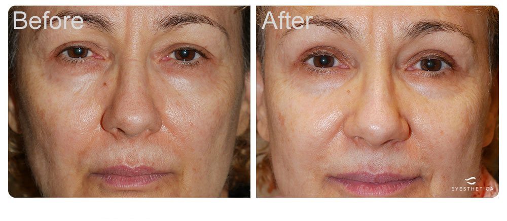 upper eyelid blepharoplasty repair los angeles