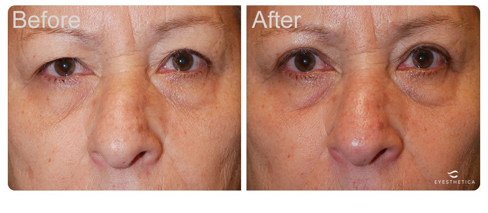 eyelid lift surgery