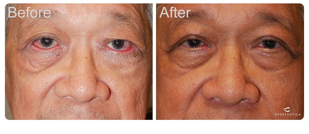 upper eyelid blepharoplasty procedure for both women and men