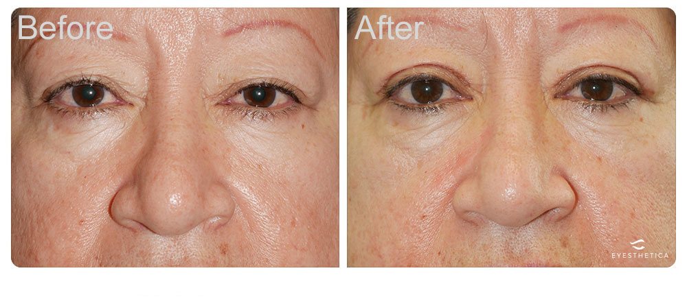 top eyelid lift surgery los angeles