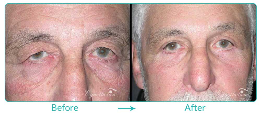 excess skin treatment for upper and lower eyelids