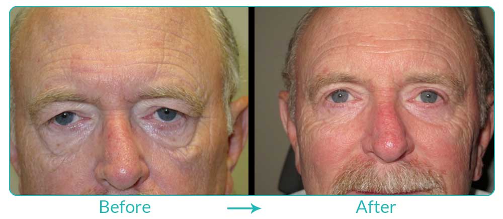 top eyelid surgery for upper and lower eyelids