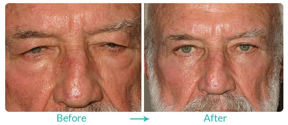 upper and lower blepharoplasty repair