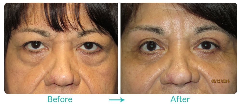 Eyelid lift and under eye bags surgery Los Angeles