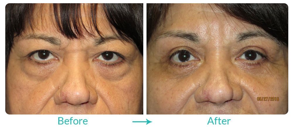 Case 244 Eyelid lift and under eye bags surgery Los Angeles