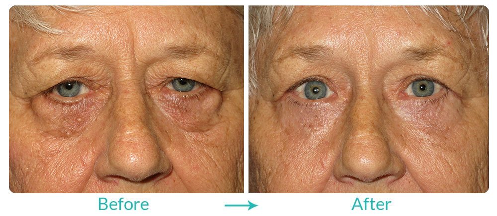 blepharoplasty treatment for upper and lower eyedlids
